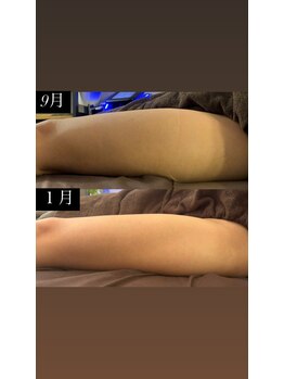 ジョワ(joie)/脚のお悩み