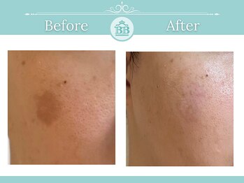 ゼロ美人 那覇店(ZERO美人)/【シミケア★シミケアZERO美人】