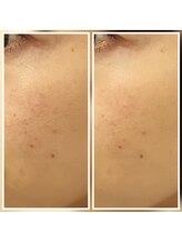 イーオ(io)/毛穴が目立たなく！