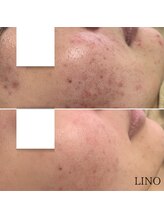 リノ(Lino)/vosサロンケア