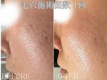 リアン 南熊本店(Lien)の雰囲気（1回でこの変化！毛穴レス×小顔［毛穴/小顔/痩身/ダイエット］）