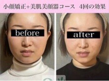 キュープ 福岡九大学研都市店(Qpu)/美顔器モニターコース４回の変化