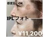 【ハリツヤ愛され肌】IPLフォト美顔（１）　顔ほぐし　プラセンタパック付