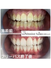 ホワイトニングサロン 京都烏丸店/ホワイトニング施術例