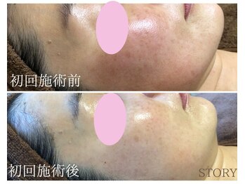 ストーリー(STORY)/ハーブピーリング専門店STORY