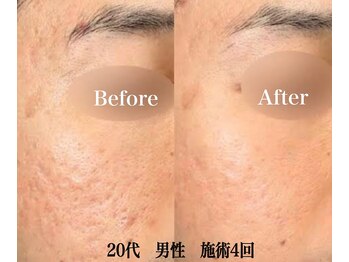 ブレア(Blair)/マイクロニードル×ピンクグロウ