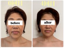 キプラ 福津店(KIPURA)の雰囲気（小顔矯正4回目でまるで別人♪(^-^)）