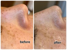 透明感増し増し！しつこい詰まり毛穴も取り除きます☆