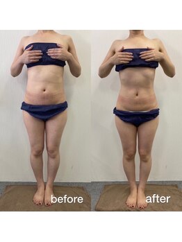 キアラ(chiara)/40代一回施術後