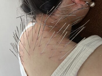 葵の葉鍼灸院の写真/その重い首肩、頭痛、もう諦めない！深層の原因へ直接アプローチし、軽やかな毎日へ◎