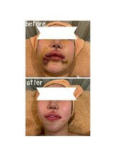 ラディアント(Radiant)/インディバ術後ケア/肌質改善