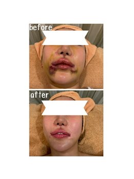 ラディアント(Radiant)/インディバ術後ケア/肌質改善