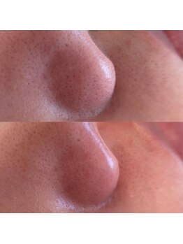 リュクスルーム(Luxe room)/潤艶WAX脱毛１回　小鼻