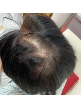 エステサロン ジジ 新宿(JIJI)/ヘッド、頭髪でお悩みの男性