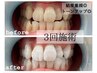 【2週間以内にご来店の方】《2回券》ホワイトニング《10分×2》×2回¥8,200→