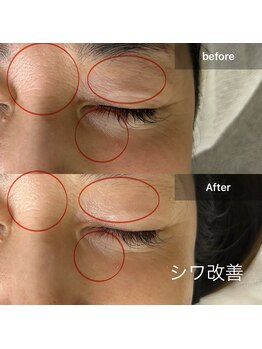 ルミエール(Lumiere)/ララピールシワケア