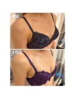 美人バスト 表参道店/【バストアップ/育乳 症例】