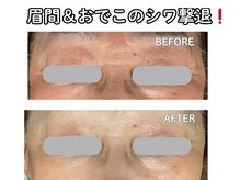 グレースティー 森町 箕面/眉間＆おでこのシワ激減！★★