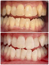 ルフレ(Reflet)/歯の内部から白く☆S38→S10