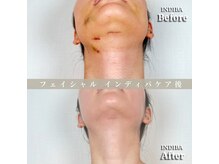 術後の女神 大阪本町店/ダウンタイムケア・インディバ