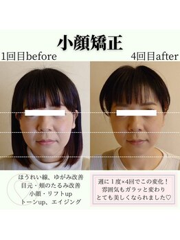 RKY/小顔矯正&頭蓋骨矯正4回(30代)