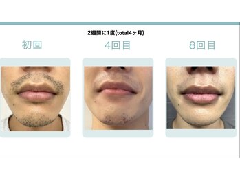 メラヴィー 上社店(meravi)/【メンズ】髭脱毛