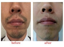 ブランリス(Blanclis)/【脱毛】メンズ脱毛　ヒゲ