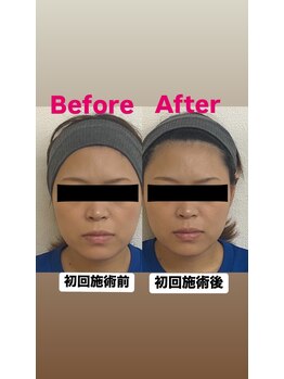 ゆうはり鍼灸整骨院 恵比寿/お客様Before　After