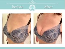 美人バスト 赤羽店/バストアップ・バストケア症例★