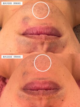 エフイーサンニーイチ(Fe-321)/ヒゲ脱毛　ビフォーアフター