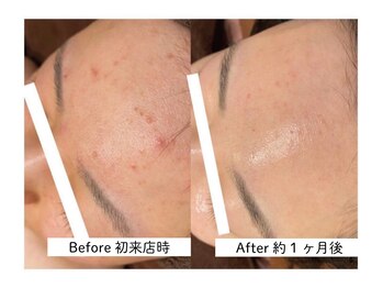 サルヴァトーレ 長崎/シミシワ改善/ニキビケア/毛穴