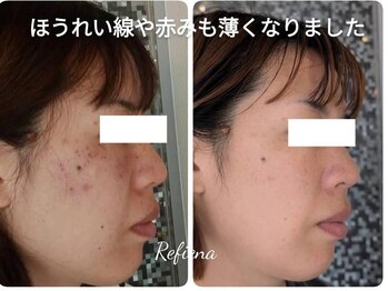 クリニカルエステ リフィーナ 辻堂店/イレイザーですっきり♪