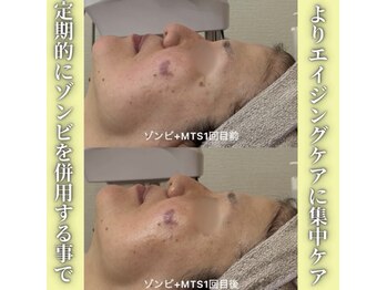 ハニエル(Haniel)/ゾンビマスク+無針水光注入症例