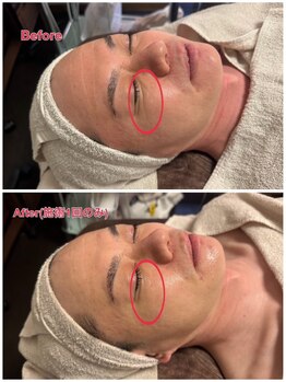 スーパースカルプ 大津店(SuperScalp)/お客様before/after写真