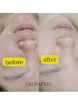 ふらっとエステ/ララピール★韓国人気No１肌ケア