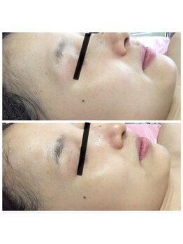 ラヴィソンファム(Ravissant femme)/20代1回効果/小顔