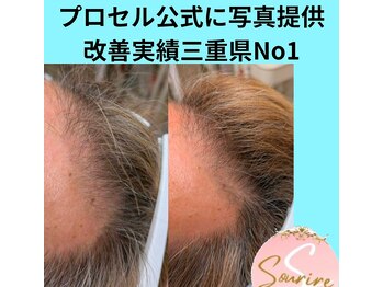 スリール(sourire)/三重県プロセル改善症例数No1