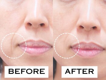 ビハリスト 麻布十番/マリオネットラインが改善!