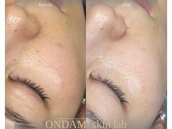 オンダム 表参道(ONDAM)/くすみ解消で透明感のある肌へ