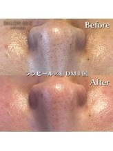 サロン ド エス アオヤマ(SALON DE S AOYAMA)/ララピール＆LDM（毛穴黒ずみ）