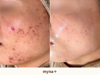 マイナプラ 表参道(myna+)の写真/原因不明の肌荒れに【敏感肌・赤み・肌荒れに】アンストレス乳酸菌ピーリング＋ヘッド ¥14800-