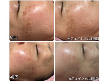 エンフィール(&.Feel)/光フェイシャル効果写真♪