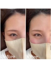 エイジレス(AGELESS)/Before After