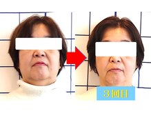 幸葉/小顔矯正その時だけ？違います！