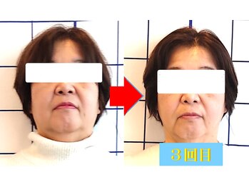 幸葉/小顔矯正その時だけ?違います!