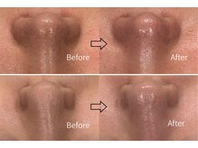 エクラ(eclat)/１回の変化　毛穴/黒ずみ/詰まり