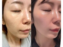 フェイスプラスリフ(FACE+RiF)