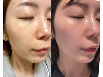 フェイスプラスリフ(FACE+RiF)の写真/肌荒れ・ニキビ・敏感肌に悩む方へ!短期集中で理想の肌質改善へ導きます☆