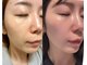 フェイスプラスリフ(FACE+RiF)の写真/肌荒れ・ニキビ・敏感肌に悩む方へ!短期集中で理想の肌質改善へ導きます☆