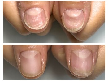 ノイルム(noilm)/爪質改善